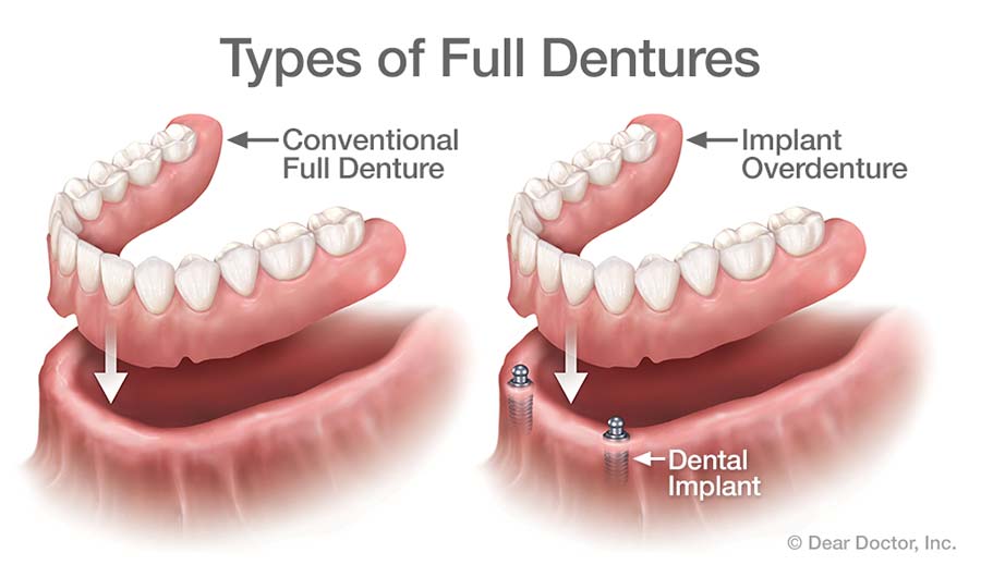 Removable Dentures Dr Charles Picchioni Bryn Mawr PA